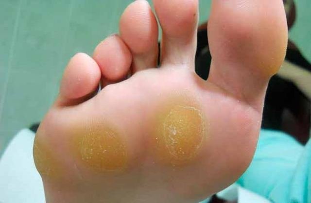Sola do pé com calosidades