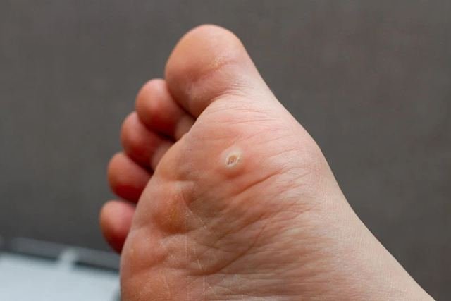 Sola do pé com verruga plantar